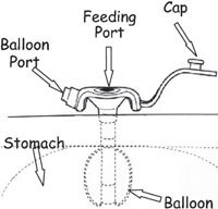 پگ دکمه‌ای (Button Gastrostomy)؛ راهکاری راحت‌تر و کم‌نمایان‌تر برای تغذیه طولانی‌مدت